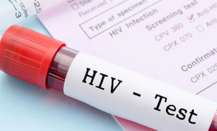 Tres ciudades del país registran el 48.5% de los casos de VIH desde 1985